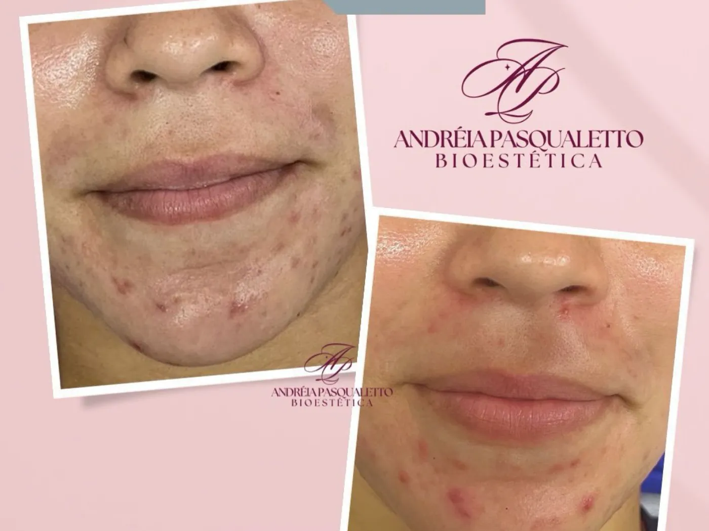 Clareamento corporal e facial