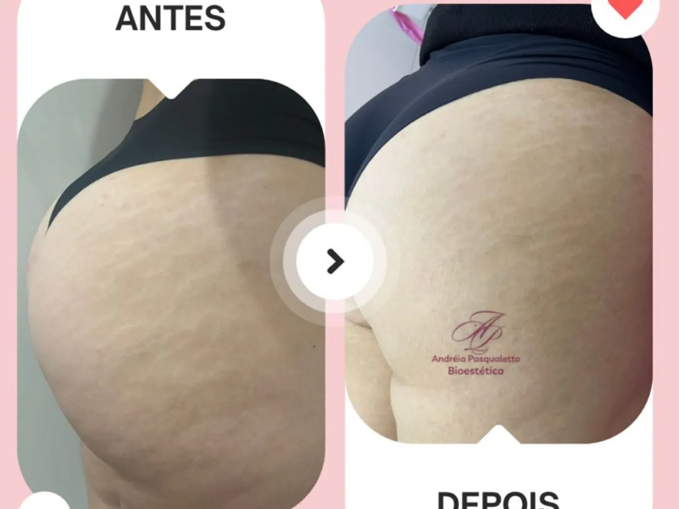 Tratamento de estrias